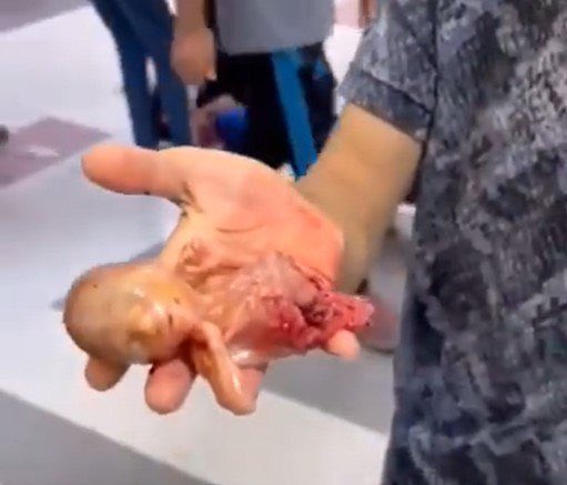 They killed fetuses before they came out of their mothers' wombs in Gaza, and the European Commission, headed by the German government, still disagrees with the view that what is happening in Gaza is "genocide" without imposing any sanctions on the terrorist Zionist occupation