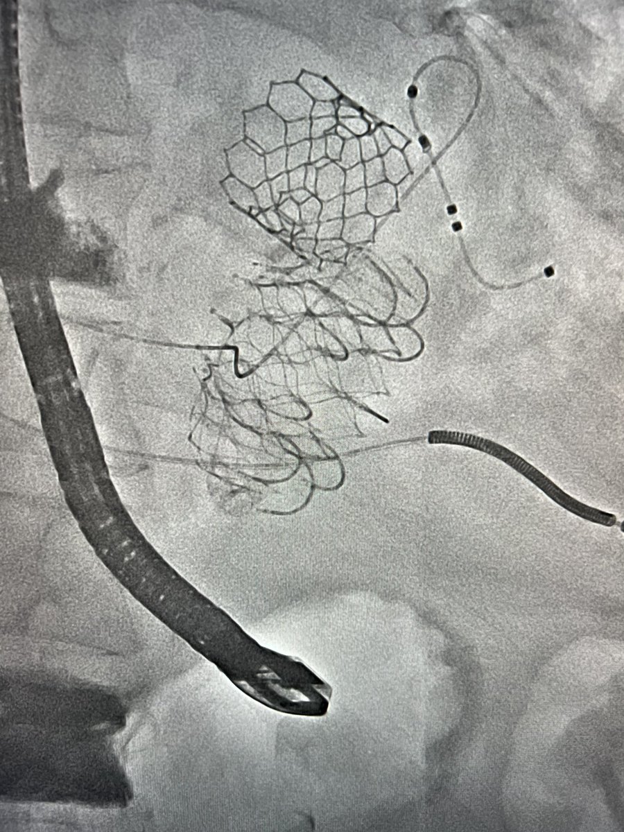 Kudos to NCH Rooney Heart Institute team for being the first in the U.S. East Coast in performing the recently FDA-approved 56mm #Evoque Valve for the treatment of severe tricuspid regurgitation. Congrats <a href="/RCubedduMD/">Roberto J. Cubeddu, MD</a> <a href="/PU84/">David R. Axline, MD, FACC</a> Dr. Pascotto &amp; structural heart team! <a href="/EdwardsLifesci/">Edwards Lifesciences</a>