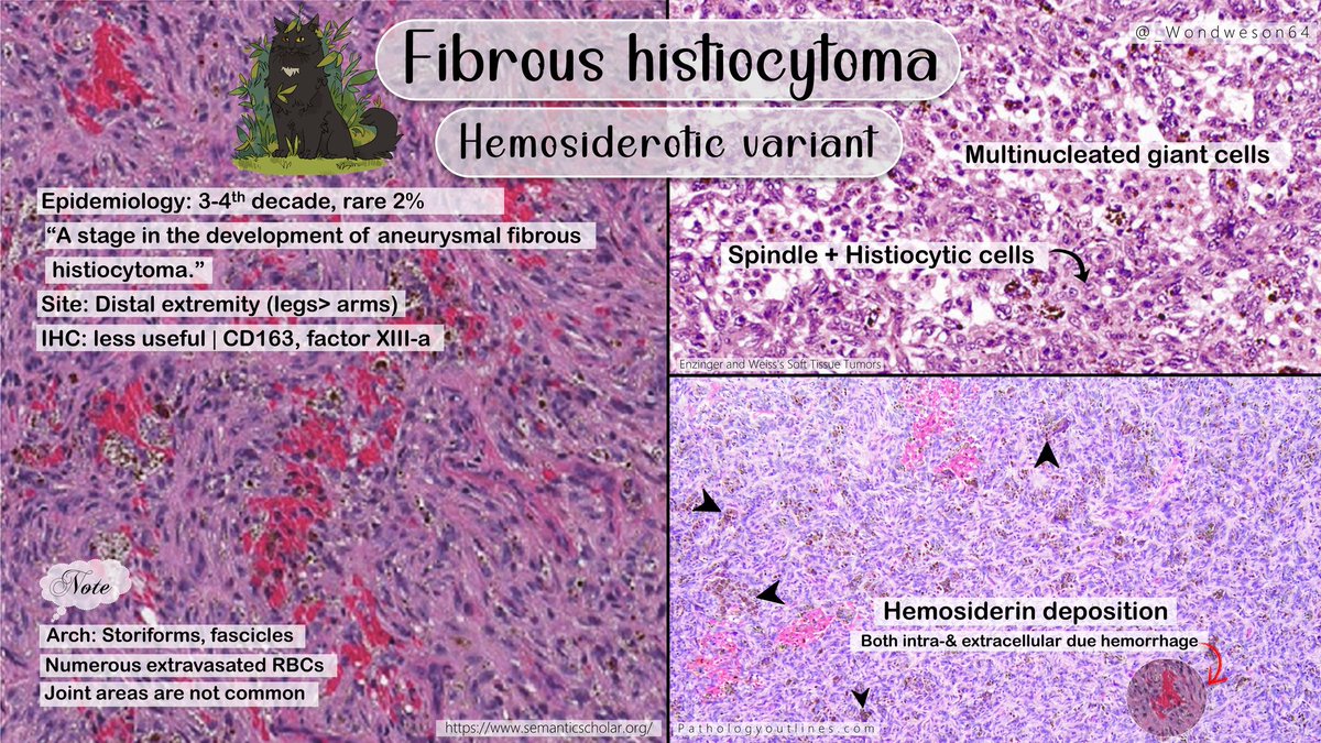 _Wondweson64's tweet photo. 🔬Diagnosis &amp; Annotated Pearls with DDx | Previous case!➴

➤ TENOSINOVIAL GIANT CELL TUMOR

#Pathresidents #PathTwitter #BSTpath @Pathologists #pathX #path2path https://t.co/VsULnu5HkS