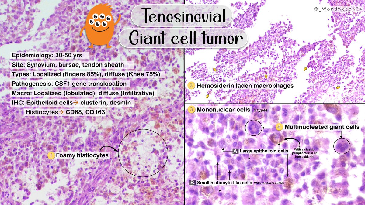 _Wondweson64's tweet photo. 🔬Diagnosis &amp; Annotated Pearls with DDx | Previous case!➴

➤ TENOSINOVIAL GIANT CELL TUMOR

#Pathresidents #PathTwitter #BSTpath @Pathologists #pathX #path2path https://t.co/VsULnu5HkS