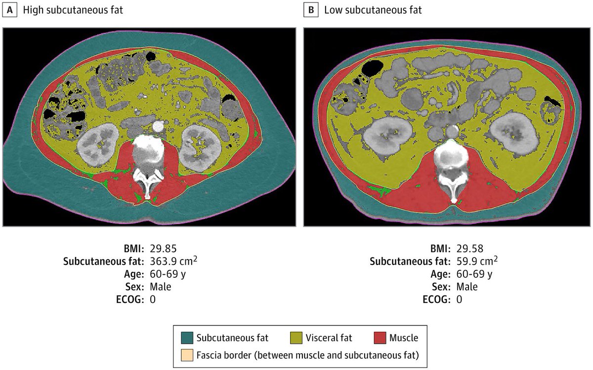 Morphomics, Survival, and Metabolites in Patients With Metastatic #PancreaticCancer
jamanetwork.com/journals/jaman…
This study really drives home the point about evaluating body composition (morphomics) in pancreatic cancer clinical trials.