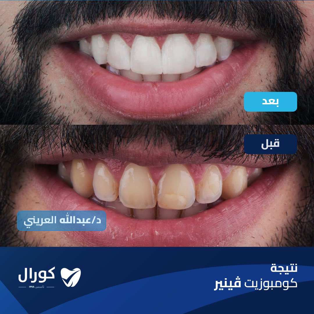 تبحث عن ابتسامة طبيعية وجذابة؟ 🦷✨
مع الComposite Veneers من د. عبد الله العريني، ستحصل على ابتسامة مشرقة وفورية.

للحجز والاستفسار:
الرقم الموحد: 966920002720+
الواتساب:
wa.me/966112253111

#عيادات_كورال #ابتسامة_مشرقة