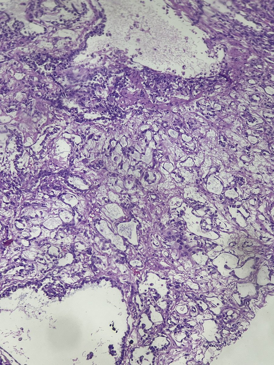 Immanuel_Paul30's tweet photo. Micros imitating the macro image comprising microcystic spaces, anastomosing cords with intervening bluish secretions !
1/M
Testicular mass
#PathX #GUpath #surgicalpath https://t.co/DsYmc0TC62