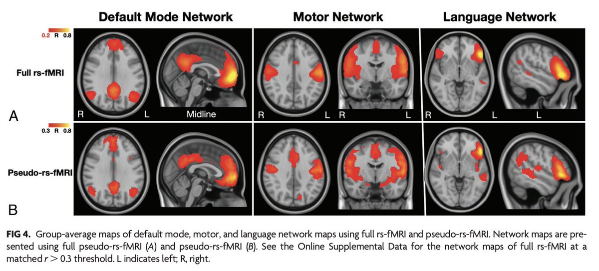 AJNR (@theajnr) on Twitter photo "Pseudo-Resting-State Functional MRI Derived from Dynamic Susceptibility Contrast Perfusion MRI Can Predict Cognitive Impairment in Glioma"
doi.org/10.3174/ajnr.A…
<a href="/theASFNR/">American Society of Functional Neuroradiology</a> "Pseudo-Resting-State Functional MRI Derived from Dynamic Susceptibility Contrast Perfusion MRI Can Predict Cognitive Impairment in Glioma"
doi.org/10.3174/ajnr.A…
<a href="/theASFNR/">American Society of Functional Neuroradiology</a>