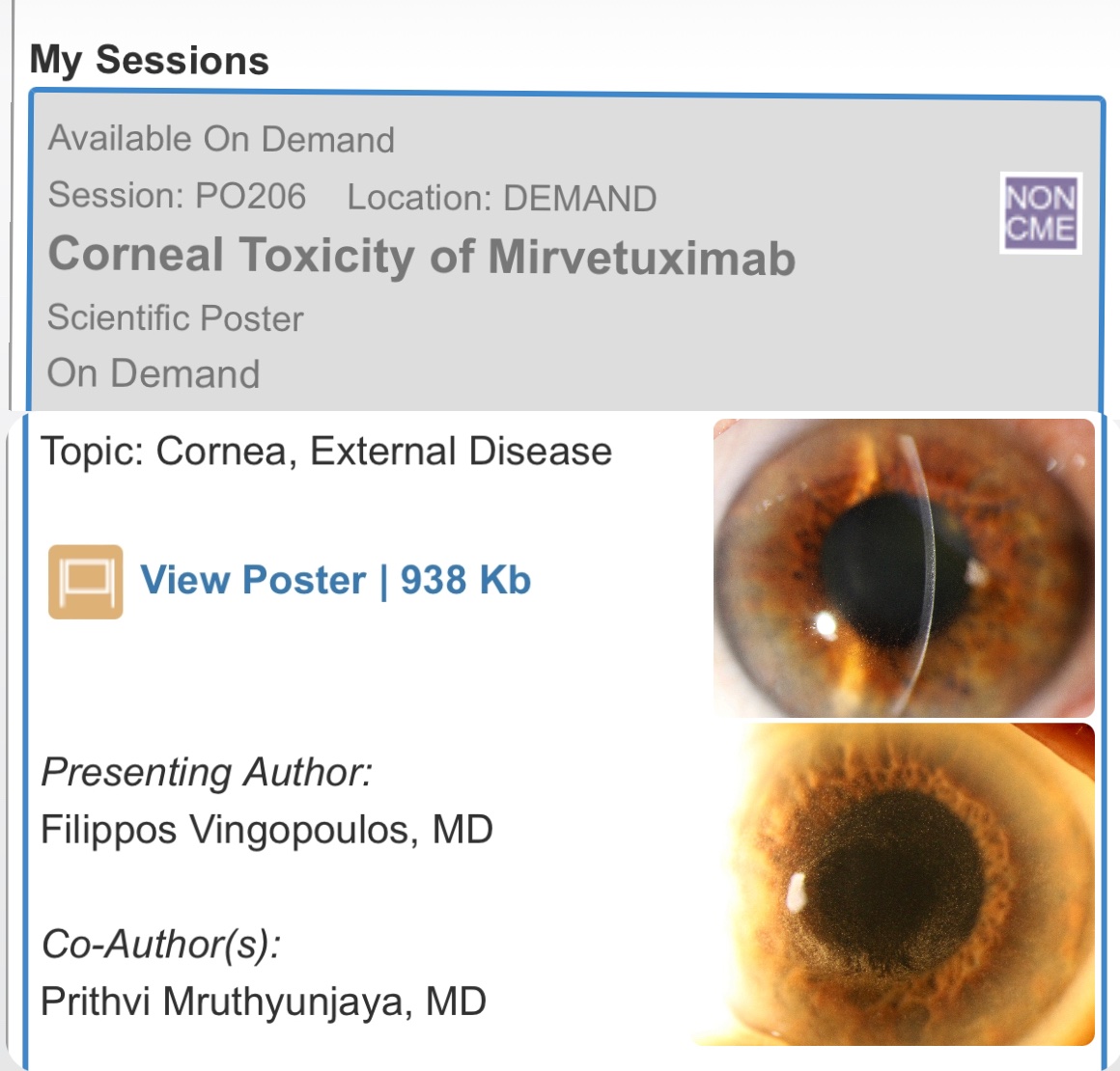 Check out our work from #Stanford #Ophthalmology at #AAO2024 on early real-world data on Mirvetuximab (#Elahere) corneal toxicity. <a href="/eyeamprithvi/">Prithvi_Mruthyunjaya</a> <a href="/aao_ophth/">AAO</a> #Chicago