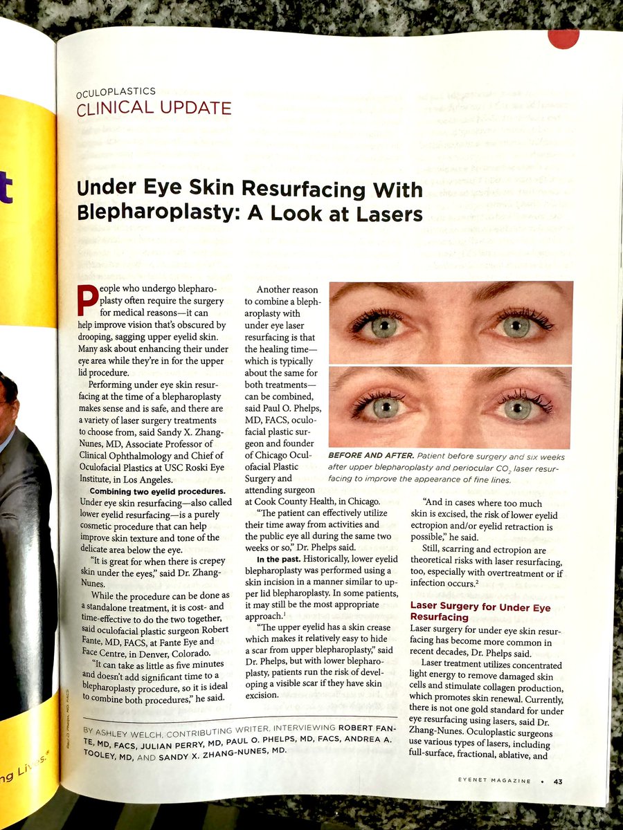 ✨👀✨ Super excited to share that I was interviewed for this awesome article on laser resurfacing in @aaoeye EyeNet magazine! 🌟 Dive into the latest insights and learn more about this innovative treatment. Check it out and let me know what you think! 📖💬 #EyeCare