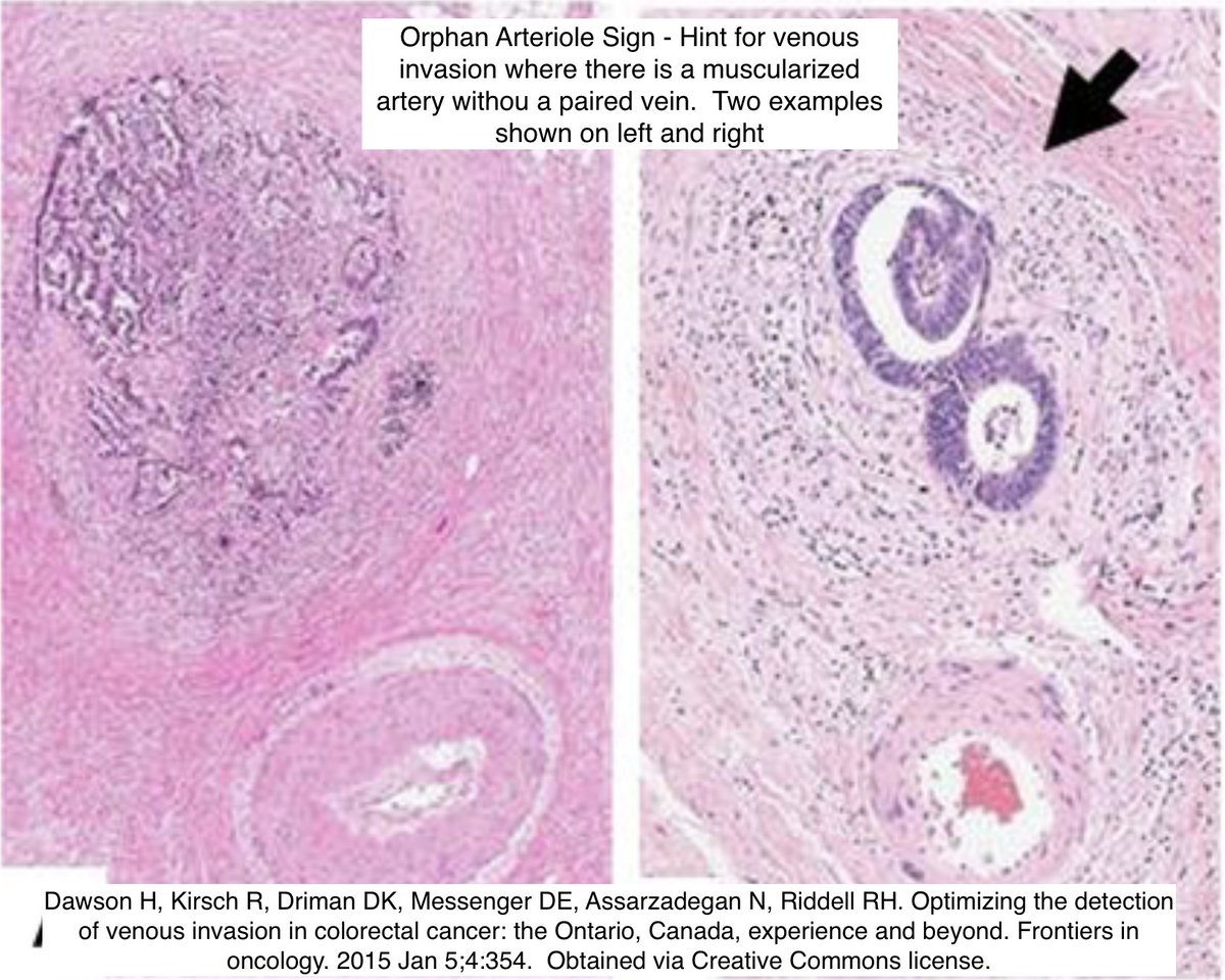 Path4People's tweet photo. 🩸 Venous Invasion in Colorectal Cancer

😰 Can be challenging 
☝️Hints: Look for "Orphan Artery" sign and "Protruding-Tongue"👅 sign (⬇️)
🎨 Use Elastin > Endothelial stains b/c latter can be lost 

#pathx #pathtip #path4people #pathagonia #gipath #pathtwitter #pathology #cancer https://t.co/1ioaKY0omR