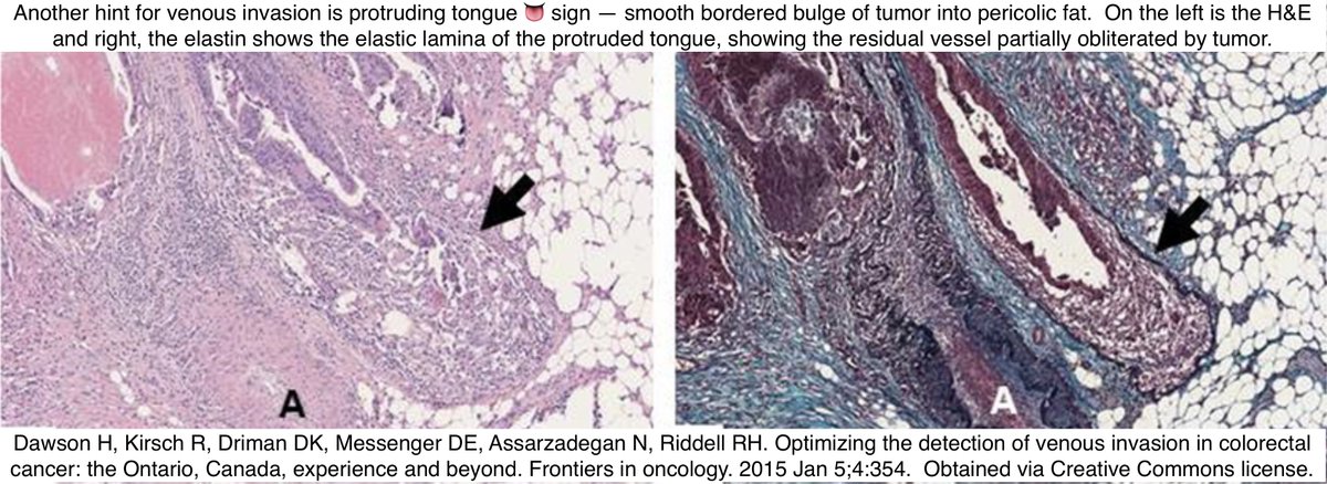 Path4People's tweet photo. 🩸 Venous Invasion in Colorectal Cancer

😰 Can be challenging 
☝️Hints: Look for "Orphan Artery" sign and "Protruding-Tongue"👅 sign (⬇️)
🎨 Use Elastin > Endothelial stains b/c latter can be lost 

#pathx #pathtip #path4people #pathagonia #gipath #pathtwitter #pathology #cancer https://t.co/1ioaKY0omR