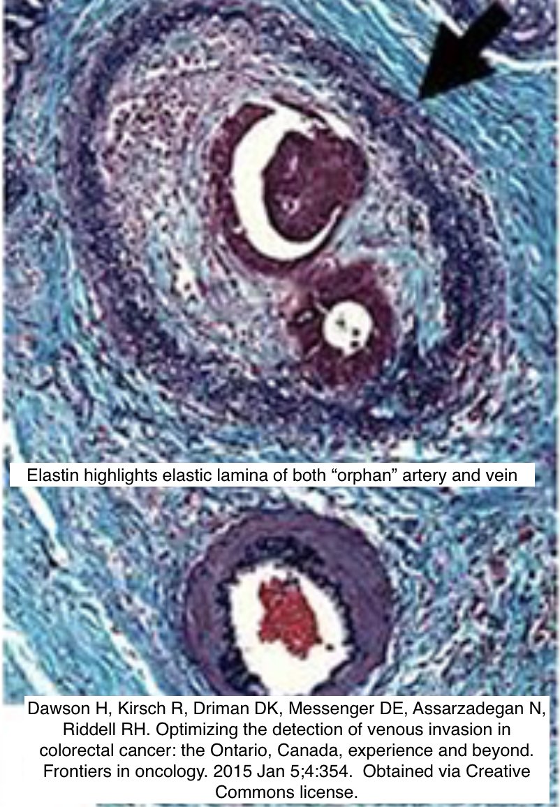 Path4People's tweet photo. 🩸 Venous Invasion in Colorectal Cancer

😰 Can be challenging 
☝️Hints: Look for "Orphan Artery" sign and "Protruding-Tongue"👅 sign (⬇️)
🎨 Use Elastin > Endothelial stains b/c latter can be lost 

#pathx #pathtip #path4people #pathagonia #gipath #pathtwitter #pathology #cancer https://t.co/1ioaKY0omR