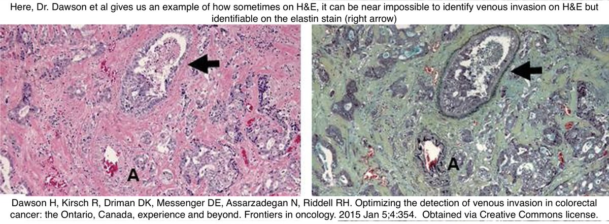 🩸 Venous Invasion in Colorectal Cancer

😰 Can be challenging 
☝️Hints: Look for "Orphan Artery" sign and "Protruding-Tongue"👅 sign (⬇️)
🎨 Use Elastin > Endothelial stains b/c latter can be lost 

#pathx #pathtip #path4people #pathagonia #gipath #pathtwitter #pathology #cancer
