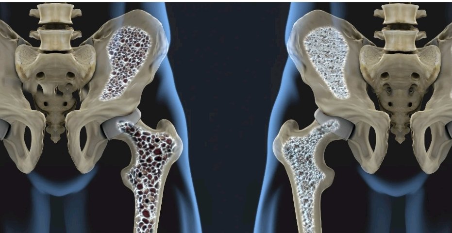 Worldwide, one in three women and one in five men aged 50 years and over will sustain a fragility fracture due to osteoporosis. #WorldOsteoporosisDay
