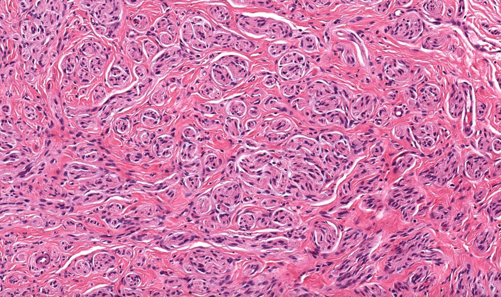 Painful nodule. Your diagnosis? What's the likely clinical history here?  WSI digital slide: kikoxp.com/posts/8018. Answer &amp; video: kikoxp.com/posts/8017. #BSTpath #pathology #pathologists #pathTwitter #dermpath #dermatology #dermatologia #dermtwitter
