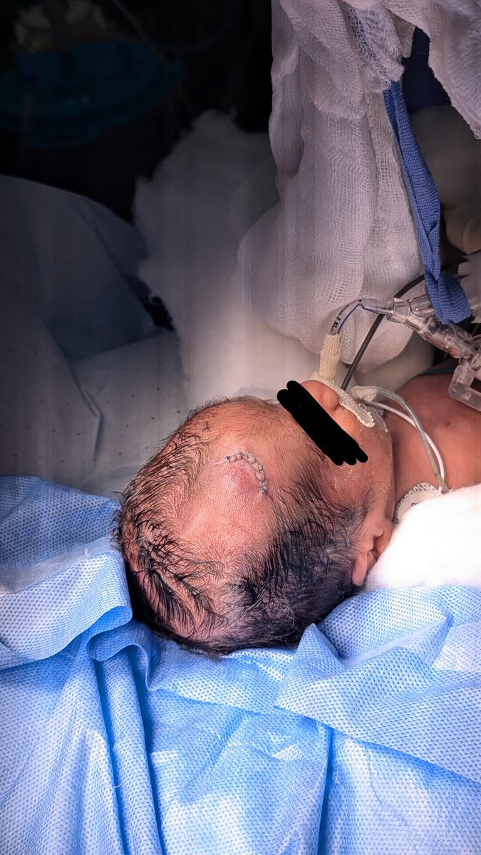 31 semanas , DV subgaleal , #ventriculosubgalealshunt #Neurosurgery