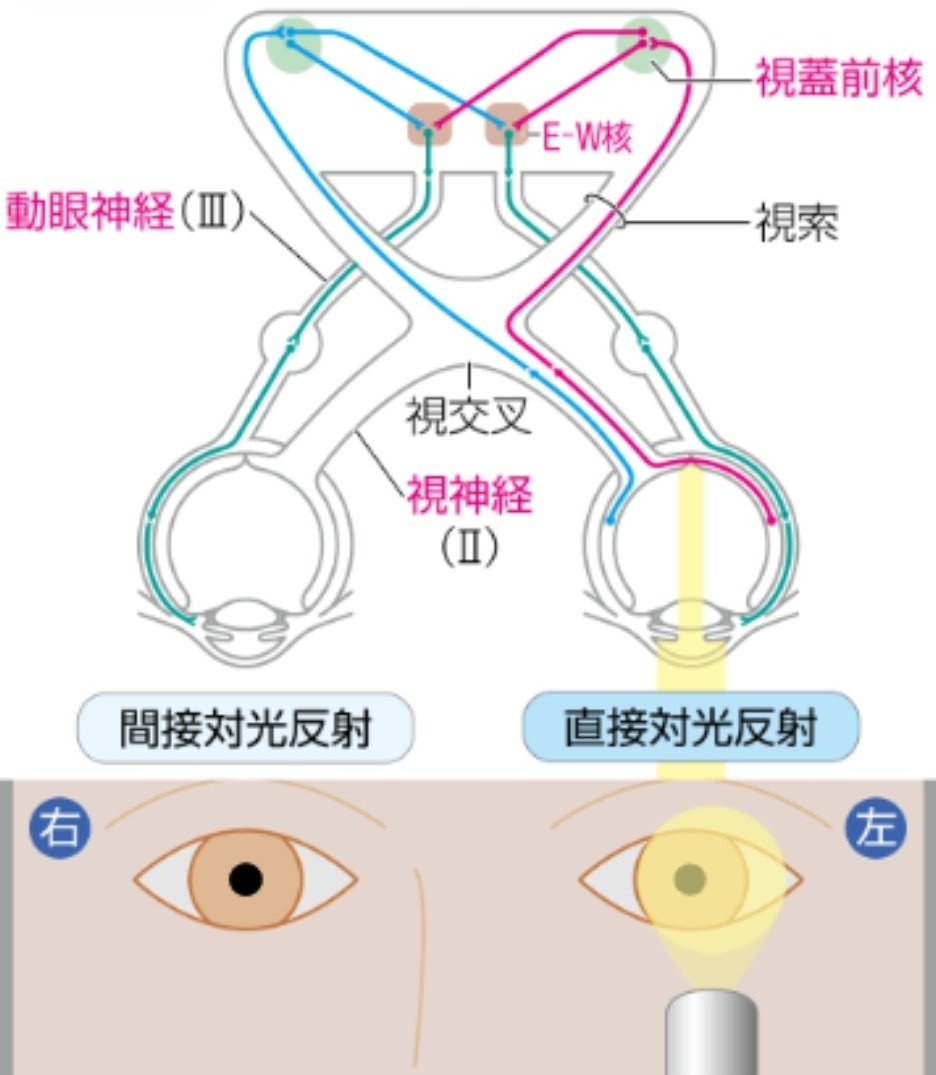 VDAQ0TW1pXlvZ8w's tweet photo. 瞳孔検査

眼球運動検査の際も必ずおこないます

なぜですって？

眼球運動はcnⅢ、Ⅳ、Ⅵ支配

そして入力系はcnⅡ
出力系の縮瞳に至っては正に先のcnⅢ内の副交感神経です

この流れで瞳孔だけ見ないのが、大変不自然に思えてきませんか？☺

(※出力系の散瞳は交感神経)

#瞳孔検査 https://t.co/cepCl5nBYA