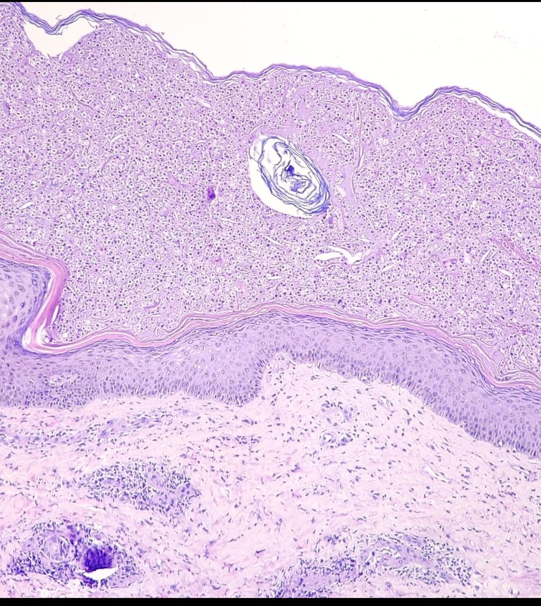 Harshit08148643's tweet photo. "Subcorneal Pustular Dermatosis: When Inflammation Strikes Just Beneath the Surface #Histology #PathologyLife https://t.co/MSJ4rtOKad