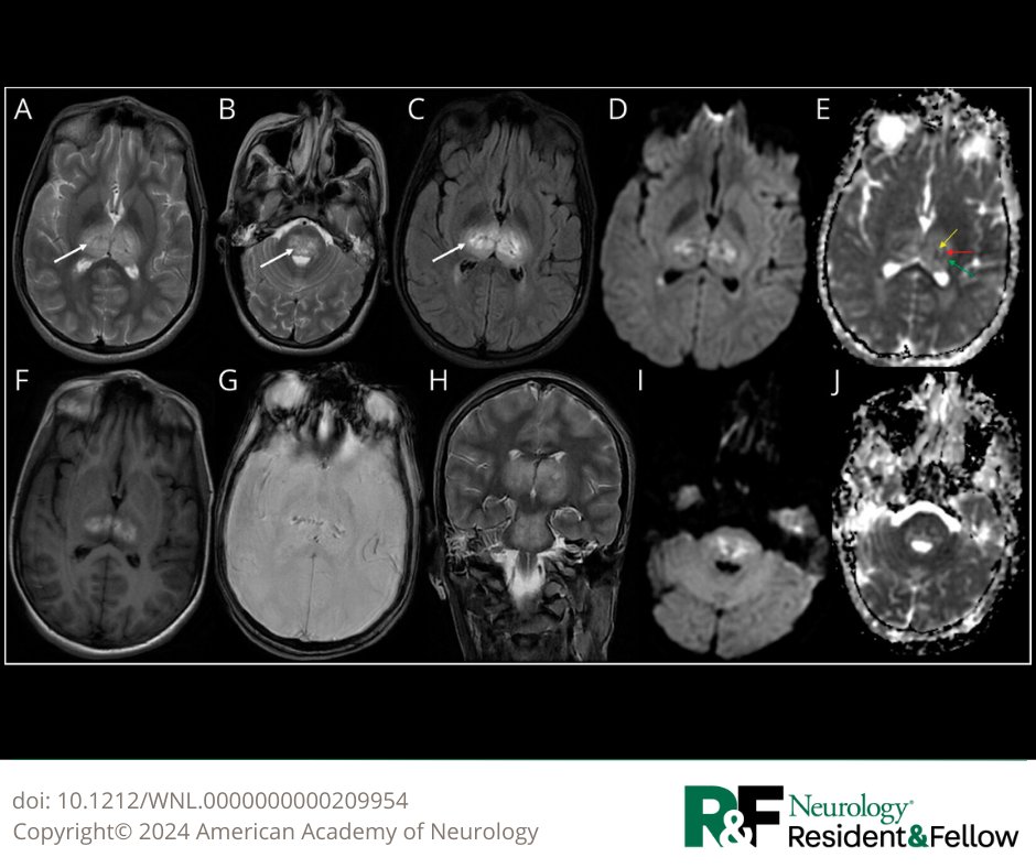 Child Neurology: Acute Necrotizing Encephalopathy of Childhood Associated With Dengue—Good Neurologic Outcome Despite a Fulminant Presentation bit.ly/3NslqUL

#NeurologyRF #NeuroTwitter