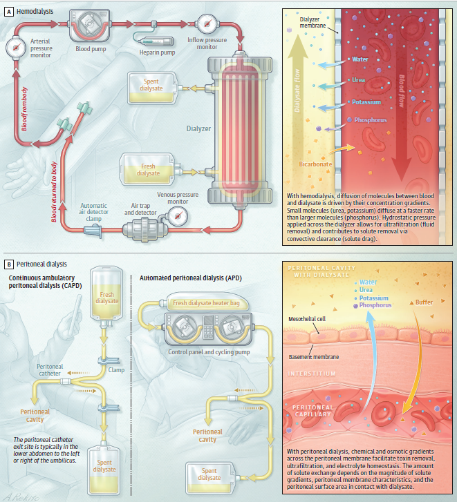 🆕 Diálisis (hemodiálisis, diálisis peritoneal) para no Nefrólogos: Todo lo que debes saber.

📕 JAMA
📁 Resumen del artículo en cardioteca.com/cardiologia-cl…