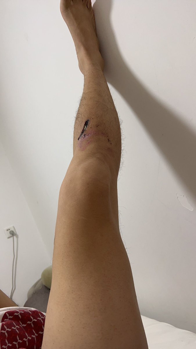 腿子……腿子快点好……酒瘾犯了