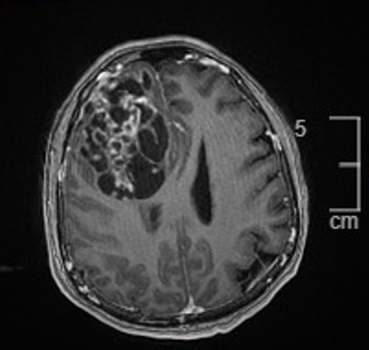 Pepe Jiménez Heffernan (@pepeheffernan) on Twitter photo CC341. Gloomy Sunday case. From neurosurgery: adult with a large frontal mass, metastasis suspected. Not uncommon for the 1st samples to be superficial, not entirely representative. It's time to be patient... Ready to report it or we wait for frozen sections? #cytopath <a href="/DrBMcGinn/">Barry McGinn</a> CC341. Gloomy Sunday case. From neurosurgery: adult with a large frontal mass, metastasis suspected. Not uncommon for the 1st samples to be superficial, not entirely representative. It's time to be patient... Ready to report it or we wait for frozen sections? #cytopath <a href="/DrBMcGinn/">Barry McGinn</a>