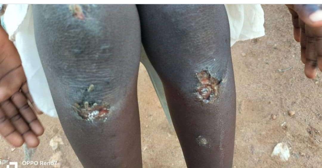 DengKuol22's tweet image. BREAKING NEWS:

A 7-year-old girl sustained injuries at a school in Juba’s Al-Baraka suburb after a teacher forced her to crawl between the school fence and classroom several times as a punishment for ‘unfinished homework’, her mother said.

#QuickRecovery
#LittleGirl 🇸🇸