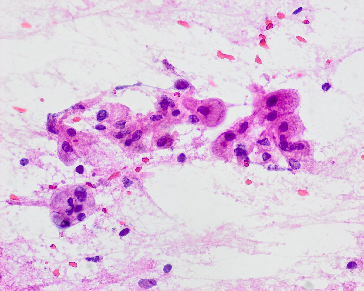 Part 2. A high power image of the tissue fragment you've pointed out and some single cells that most probably are not macrophages.