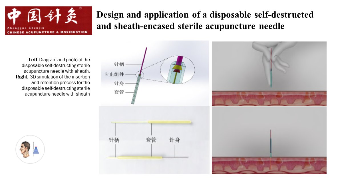 ⚪L’aiguille d’acupuncture 🇨🇳
📰Zhongguo Zhen Jiu
Mise au point d’une aiguille d'acupuncture avec mécanisme de sécurisation après usage. Au retrait de l’aiguille, rétraction automatique dans un étui plastique.

pubmed.ncbi.nlm.nih.gov/38986601/