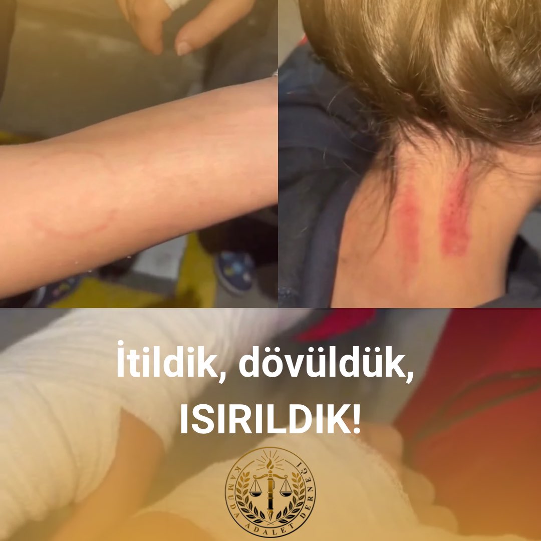 İddiaya göre Avcılar'da vakaya giden 112 ekibi ısırılarak,hakarete maruz kaldı. Sağlıkta şiddetin her türlüsüne savaş açmış olan Kamuda Adalet Derneği olarak, yaşanılan her türlü şiddet olayıyla ilgili her zaman maddi, manevi ve hukuki destek sağlamaya hazırız. #BeyazKod1111