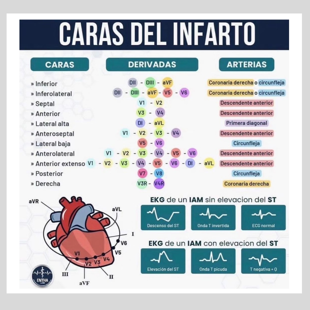 🌀CARAS  DEL  INFARTO  

#ENARM_INTENSIVO #ENARM2025 #ENARM