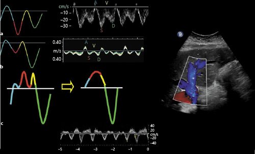 ZHeart11768530's tweet photo. 🔴Point of Care Ultrasonography for Objective Assessment of Heart Failure: Integration of Cardiac, Vascular, and Extravascular Determinants of Volume Status #openaccess #Review 

https://t.co/ofO3ZWwuTC
 #CardioEd #Cardiology #CardioTwitter #ENARM #2024Review #MedEd https://t.co/bMxW1V3K4M