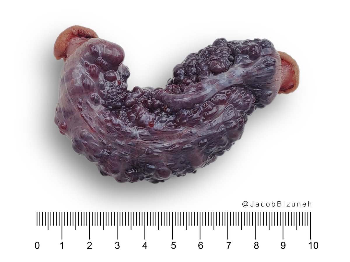 ✨ Pathology is always thrilling!!  
When the gross morphology👀speaks volumes, it’s time to investigate.
Think you can pinpoint 🎯 
➺  the site?  
➺ Diagnosis?

#PathX #Pathresidents #Surgpath #PathTwitter #grossing <a href="/Pathologists/">CAPathologists</a> #GIpath
#path2path