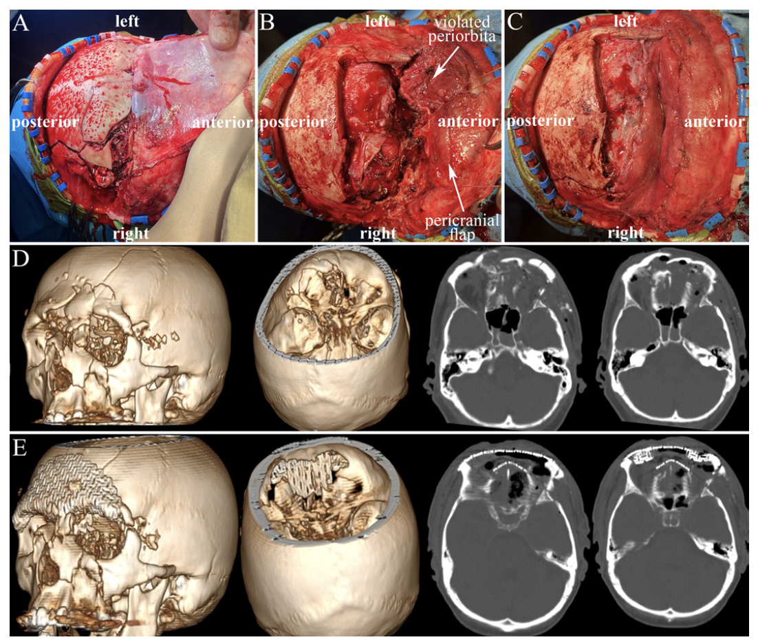 #OnlineFirst: Wartime penetrating traumatic brain injury of the anterior skull base involving the paranasal sinuses: a single-center, first-year experience from Dnipro, Ukraine. 

thejns.org/view/journals/….