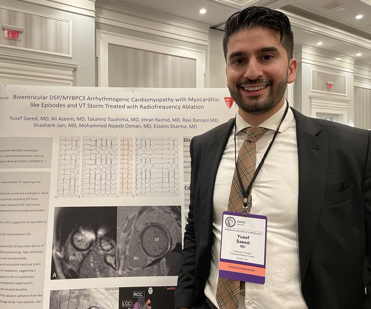Yusef Babar Saeed (@imyusefsaeed) on Twitter photo Learned a lot at <a href="/OhioACC/">Ohio Chapter-ACC</a> this weekend. Also had a chance to present a rare case with of biventricular arrhythmogenic cardiomyopathy with myocarditis like episodes and VT storm who underwent a successful endocardial and epicardial ablation by <a href="/EsseimS/">Esseim Sharma, MD</a> Learned a lot at <a href="/OhioACC/">Ohio Chapter-ACC</a> this weekend. Also had a chance to present a rare case with of biventricular arrhythmogenic cardiomyopathy with myocarditis like episodes and VT storm who underwent a successful endocardial and epicardial ablation by <a href="/EsseimS/">Esseim Sharma, MD</a>
