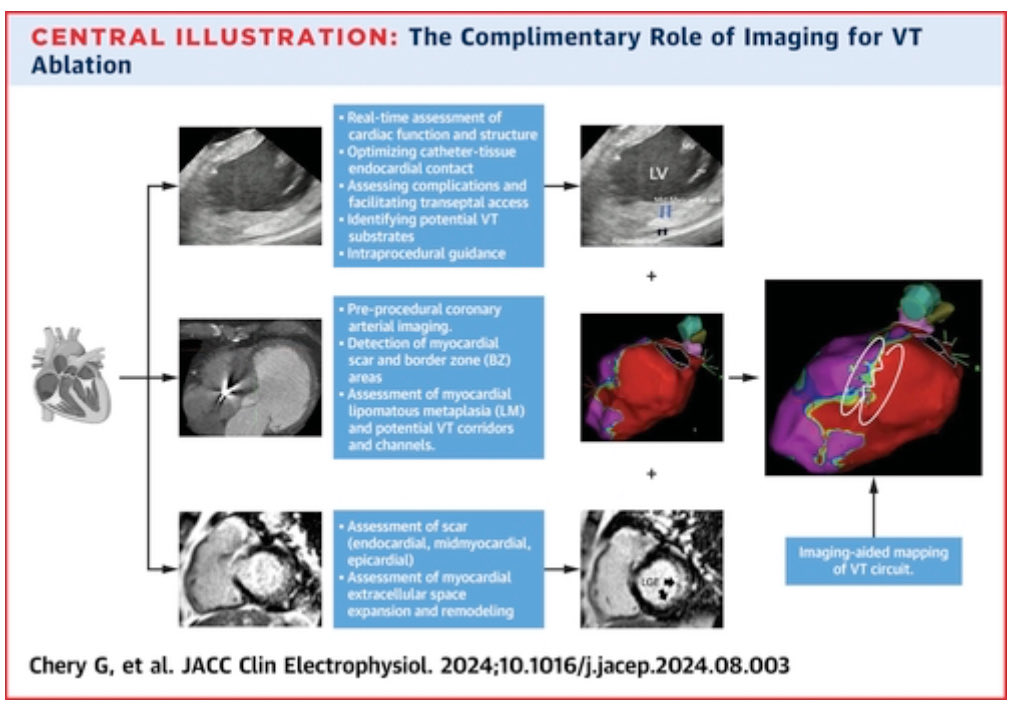 Ed_Alania's tweet photo. 🔴 Imaging to Facilitate VT Ablation: Intracardiac Echocardiography, Computed Tomography, Magnetic Resonance, &amp; Positron Emission Tomography @JACCJournals #Cardiology #cardioEd #whyCMR #yessCT #cvNuc https://t.co/ItC2iazX2c