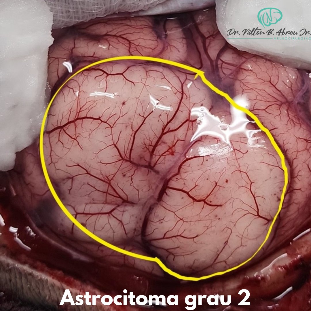 NiltonAbreu's tweet photo. Astrocitoma (grade 2 - WHO)
#drniltonabreu #astrocitoma #tumorcerebral #braintumor #issoaí #anatomiapatologica #anatomia #neurocirurgia #cirurgia #brainsurgery #ok #tratamento #neuro #muriae #juizdefora #conhecimento #doença #foda #neurociencia #who #oms #saude #cura #vamosnessa https://t.co/PMrfw7Tj7I