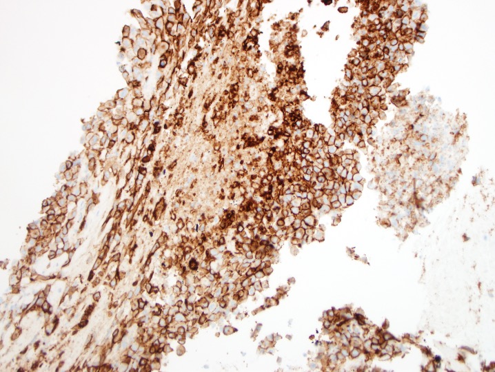 Nooshin_Dashti's tweet image. Destructive femur mass. Bx: CD31 and FLI-1. Note the epi morph. #BSTP