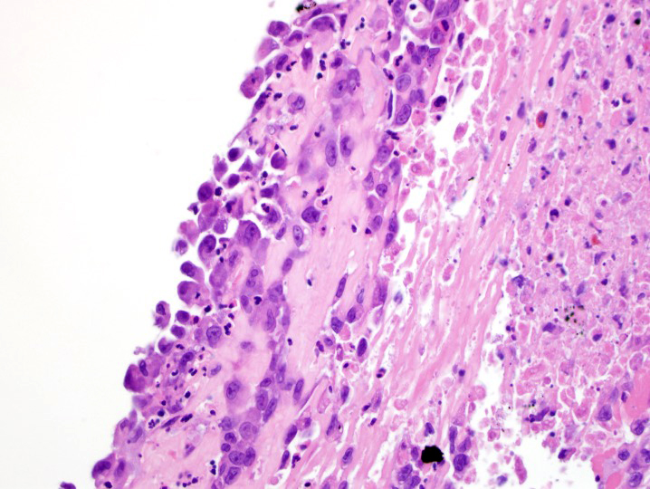 Nooshin_Dashti's tweet image. Destructive femur mass. Bx: CD31 and FLI-1. Note the epi morph. #BSTP