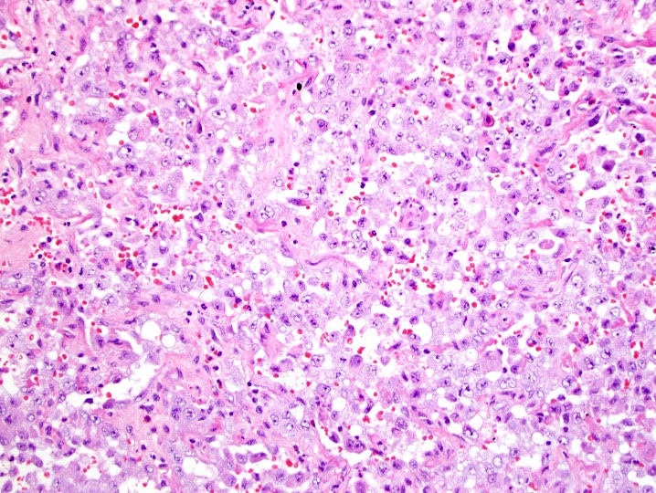 Nooshin_Dashti's tweet image. Destructive femur mass. Bx: CD31 and FLI-1. Note the epi morph. #BSTP
