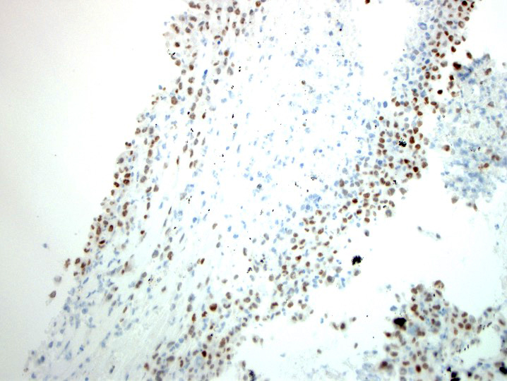 Nooshin_Dashti's tweet image. Destructive femur mass. Bx: CD31 and FLI-1. Note the epi morph. #BSTP
