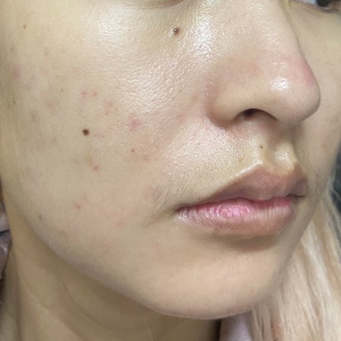 zl92x's tweet photo. อยากให้น้อง Callis แมสมาก เลิฟมากตัวนี้
• 5 Peptide Complexes
• 5% Niacinamide หรือ วิตามินบี3
🫶🏻 ดูแลผิวให้กระจ่างใสและอ่อนเยาว์
🫶🏻 ลดรอยดำและรอยแดงให้จางลง
🫶🏻 ไม่ทำให้ผิวระคายเคือง
🫶🏻 รูขุมขนเล็กลง
🫶🏻 ผิวเรียบเนียนขึ้น
#ป้ายยา #หน้าเป็นสิว #สิวฮอร์โมน #Callis #เซรั่มเปป์ไทด์ https://t.co/b7cc9SZiLr
