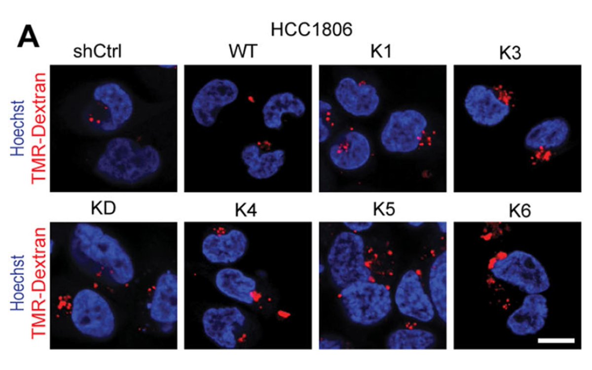 Last week's stellar set of papers on #cancer #metabolism and #glutamine via <a href="/Bims_BiomedNews/">Bims: Biomed News</a> 

biomed.news/bims-glucam/20…

Top pick: Macropinocytosis mediates resistance to loss of glutamine transport in triple-negative breast cancer pubmed.ncbi.nlm.nih.gov/39420093/