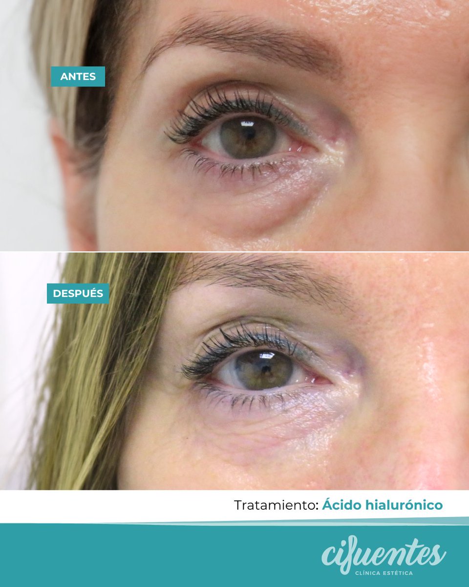 cifuentesclinic's tweet photo. Cómo rejuvenecer tu mirada sin cirugía.👁️

ℹ️ Existen diferentes tratamientos que permiten eliminar el aspecto de mirada triste y cansada como el relleno con ácido hialurónico, #Plexr, el #HIFUPeriocular o incluso, el peeling periocular, entre otros. https://t.co/gsf7AYt5Xf