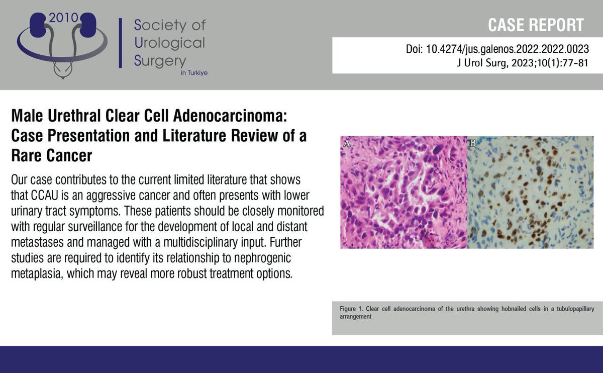 JUsurgery's tweet photo. Male Urethral Clear Cell Adenocarcinoma: Case Presentation andLiterature Review of a Rare Cancer
You can see the free full text of the research by Basil Razi et al.
Link : https://t.co/nTlRXe6PlM
#Clearcell #adenocarcinoma #urethral #cancer #nephrogenic #metaplasia https://t.co/bu41w02TLb