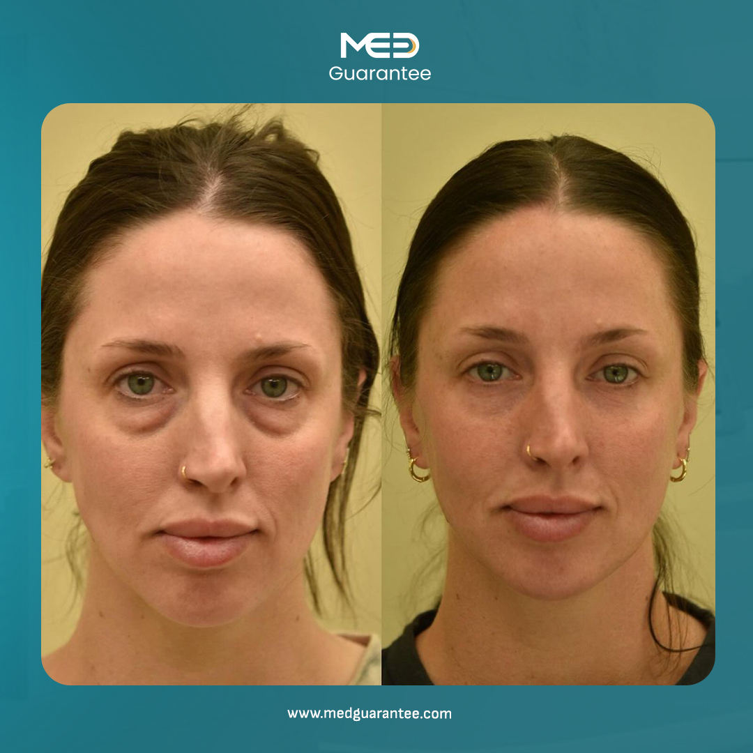 Medguarantee's tweet photo. 🌟The results are subtle yet impactful my eyes feel brighter, and I look more awake and youthful!🌟

✨ Brighten your look with expert blepharoplasty care ✨

🌐https://t.co/gqGxhXgJ4i
📞 +90 850 441 9109

#Blepharoplasty
#EyelidSurgery https://t.co/zySmeEVk1j