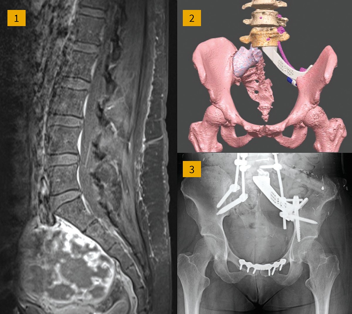 WashU Med Taylor Family Department of Neurosurgery (@washuneurosurg) on Twitter photo Learn how <a href="/washumedicine/">WashU Medicine</a> Neurosurgeons Camilo Molina, MD (<a href="/CamiloMolinaMD/">Camilo A Molina MD</a>), Jacob Greenberg, MD (<a href="/JGreenberg_MD/">Jacob Greenberg, MD, MSCI</a>), and their <a href="/WashUMedOrtho/">WashU Medicine Orthopedics</a> colleagues are forging a new frontier in surgery to treat complex #spinal conditions.:bit.ly/4hkYyUN Learn how <a href="/washumedicine/">WashU Medicine</a> Neurosurgeons Camilo Molina, MD (<a href="/CamiloMolinaMD/">Camilo A Molina MD</a>), Jacob Greenberg, MD (<a href="/JGreenberg_MD/">Jacob Greenberg, MD, MSCI</a>), and their <a href="/WashUMedOrtho/">WashU Medicine Orthopedics</a> colleagues are forging a new frontier in surgery to treat complex #spinal conditions.:bit.ly/4hkYyUN