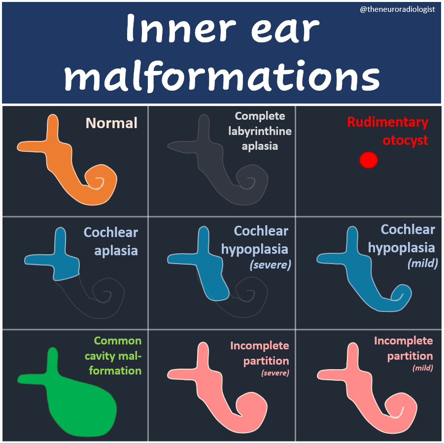 Inner ear malformations made easy (a non-exhaustive overview focussing on the cochlea; many of these can be further subdivided, but you've got to start somewhere). #radres #radiology #MedEd #FOAMed #FOAMrad #RadEd