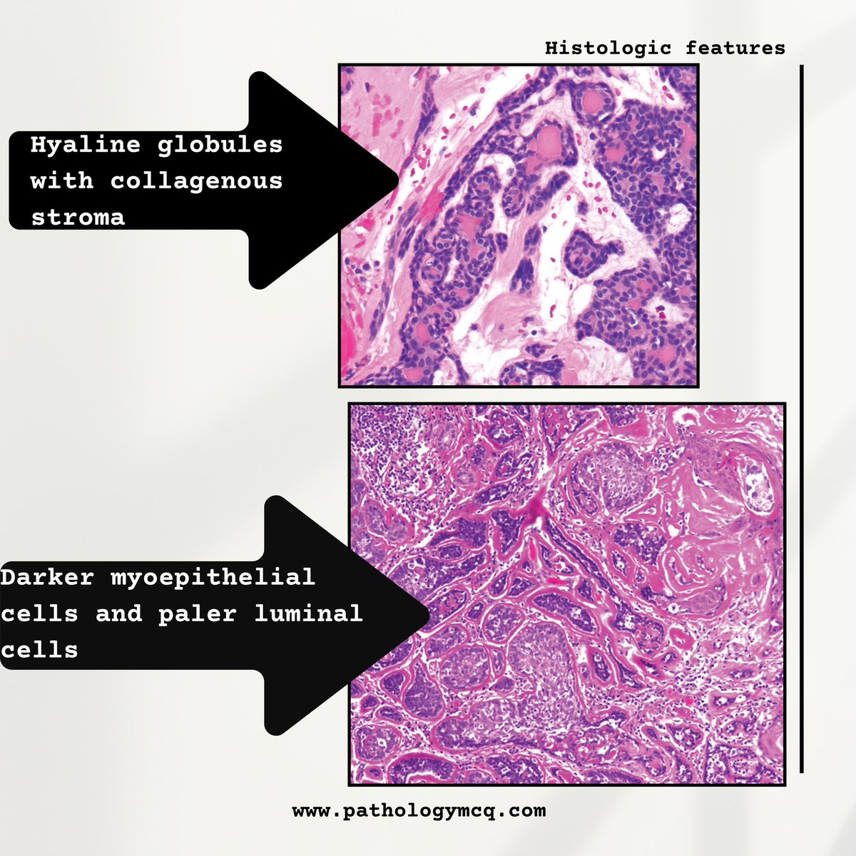 Pathology_mcqs's tweet photo. Some Key features associated with Basal Cell adenoma https://t.co/D2cltS7CeC