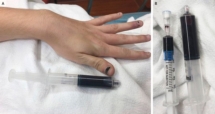 farmacotips's tweet photo. Paciente con sangre azul. 

¿Cual es tu diagnóstico?