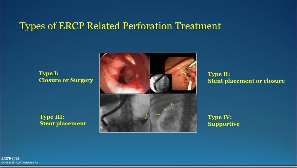 CarlKayMD's tweet photo. Four Types of ERCP Perforations

▪️Stapfer I: Lateral/medial duodenal wall (caused by the endoscope)

▪️Stapfer II: Periampullary perforations

▪️Stapfer III: Distal bile duct injuries 
(related to instrumentation)

▪️Stapfer IV: Retroperitoneal air alone

Management 👇

#ACG2024 https://t.co/lQQl0DoVt9