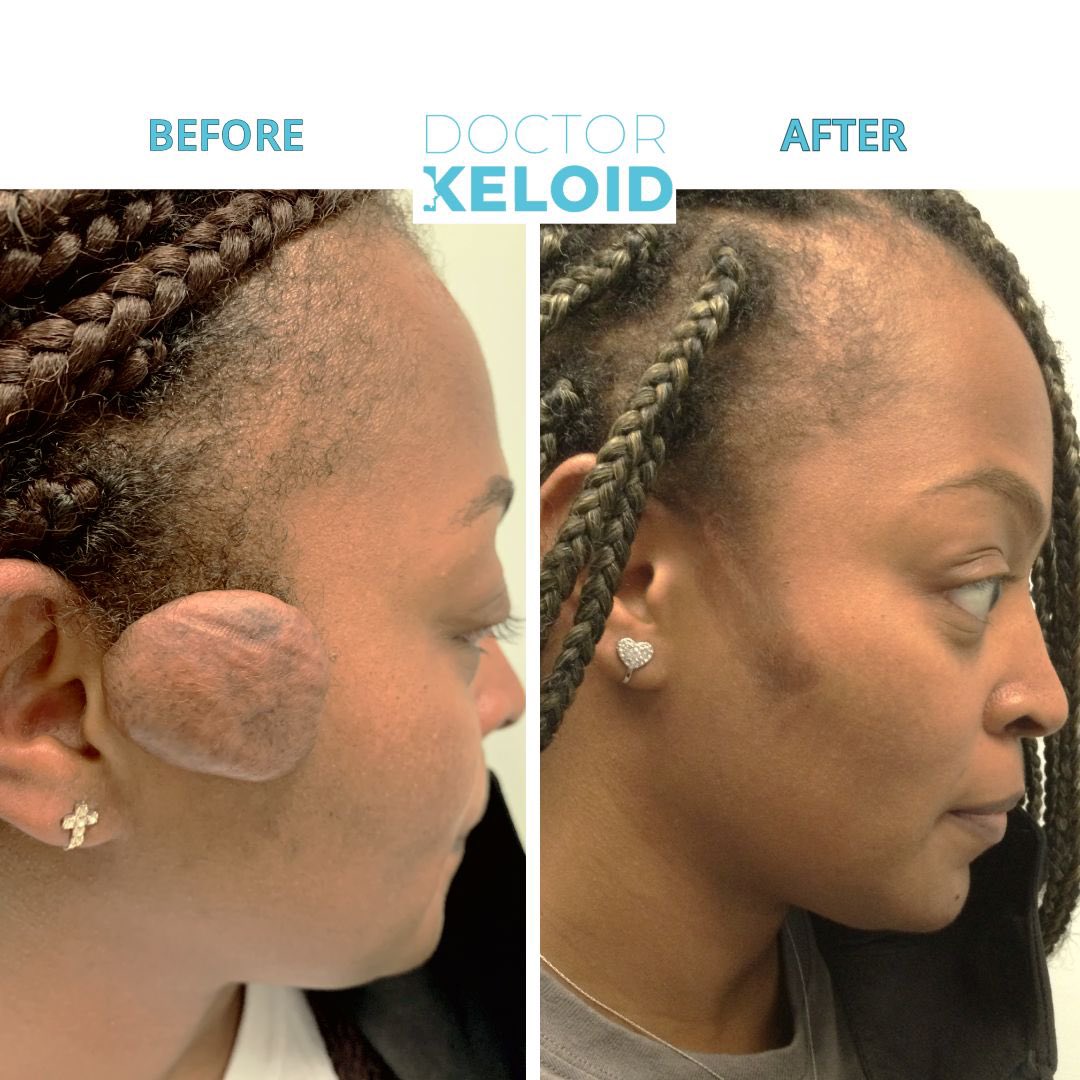 DrKeloid's tweet photo. Get the BEST Keloid Care you need! ✨ With a 95% success rate removal and NO reoccurring growth, you’ll be thankful to choose #DrKeloid ✨ Don’t forget your #KeloidCare to minimize scarring post surgery!
Book your consultation now at the link in our bio https://t.co/61fyVAqe0V