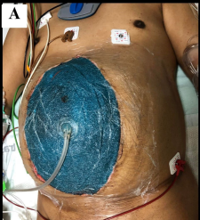 TSACO_AAST's tweet photo. *New abdominal wall closure device just dropped*

For those that prefer non-Twitter phrasing:

Naveed et al from @UofTTrauma reported on a device to facilitate earlier abdominal wall closure after damage control laparotomy.  Did it work? See below👇 

➡️https://t.co/PpSG0KMmaZ https://t.co/QkDzA8fPCq